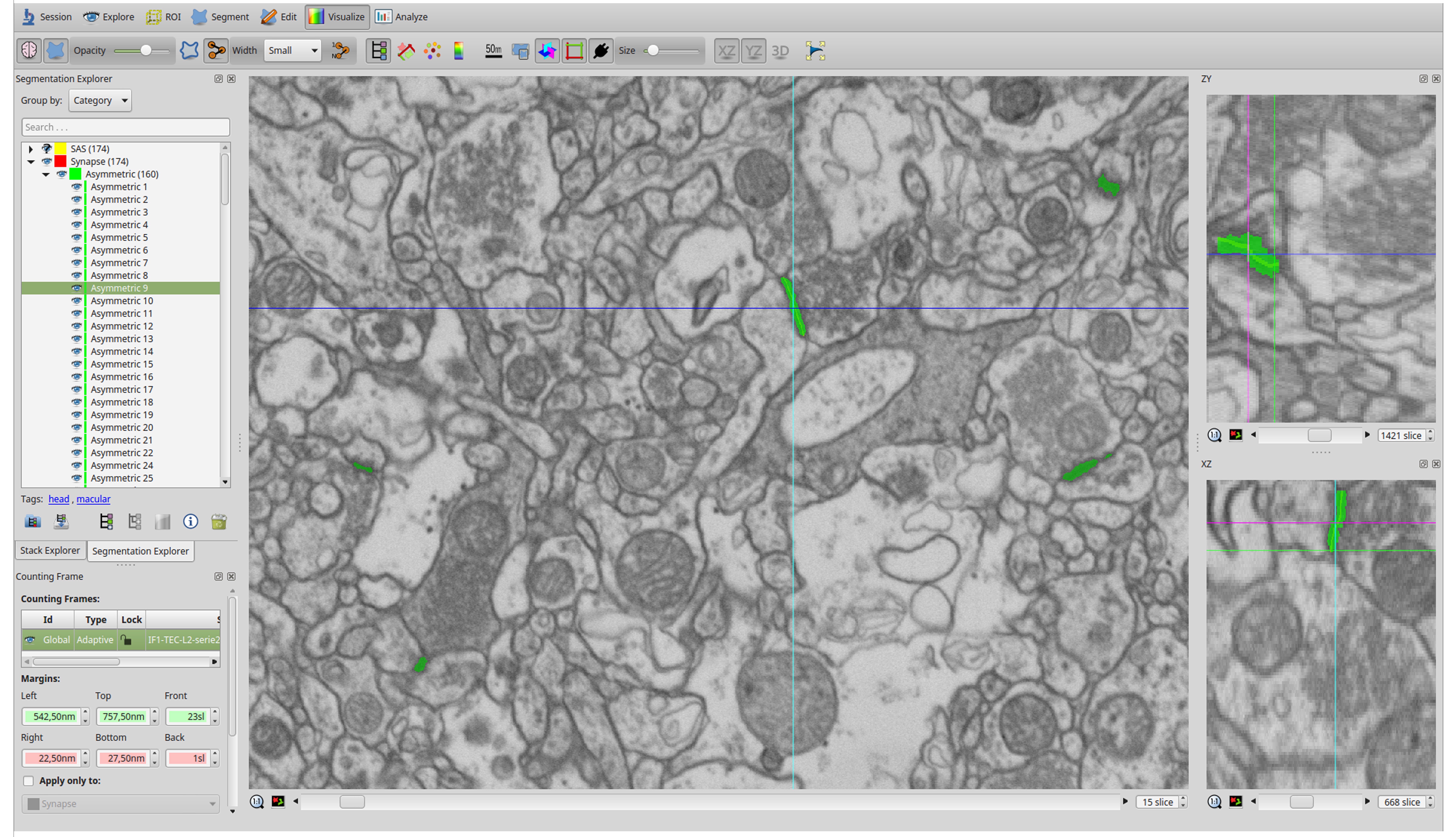 Screenshot of the software user interface (EspINA). In the main window, the sections are viewed through the xy plane (as obtained by FIB/SEM microscopy). The other two orthogonal planes, yz and xz, are also shown in adjacent windows (on the right). The list of identified synapses is shown on the left. Synapses are colored in green. (From Figure 3 of Dominguez-Álvaro et al. 2019, eNeuro).