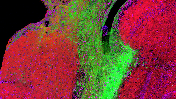 This 3D reconstruction of immunofluorescence staining shows microglial cell activation (Green, Iba1 marker) 30 days after an embolic stroke, with infiltration of the hippocampal formation and reduced density of synaptic connections (Red, SV-2) among neurons (Magenta, NeuN). This invasion can be inhibited by early targeting of the complement components of innate immunity.
